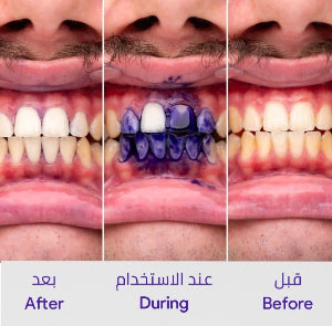HiSmile V34 Teeth Brightening Serum – Instant Color Corrector